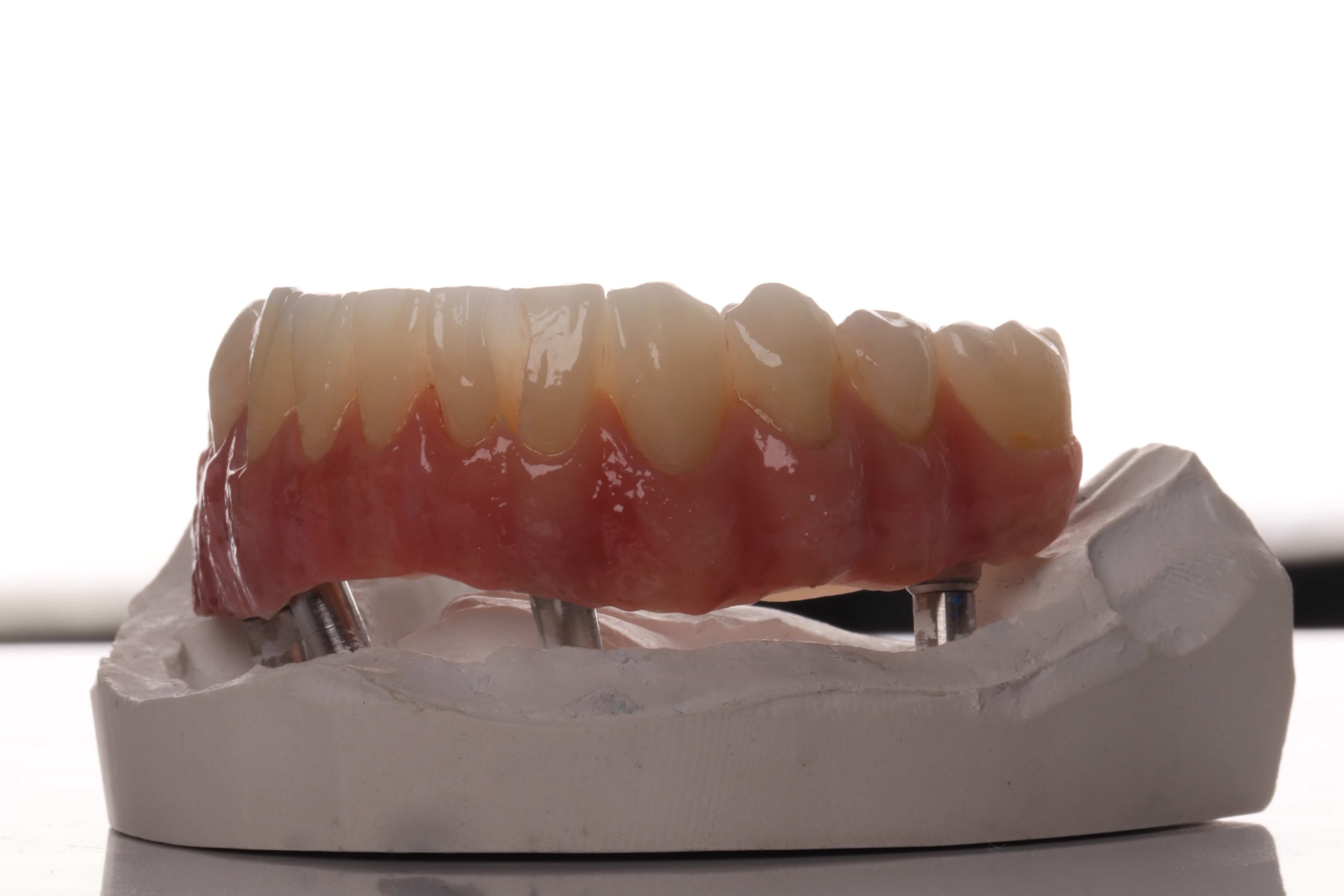 Rehabilitación dental